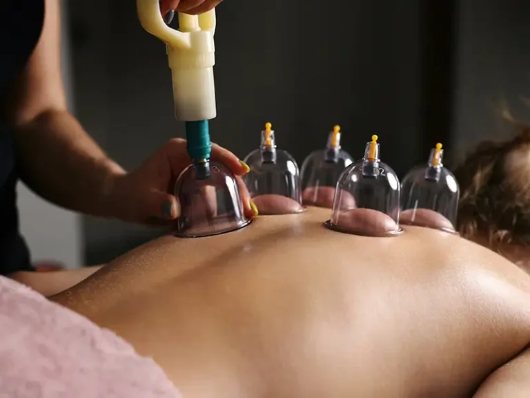 Cupping Therapy