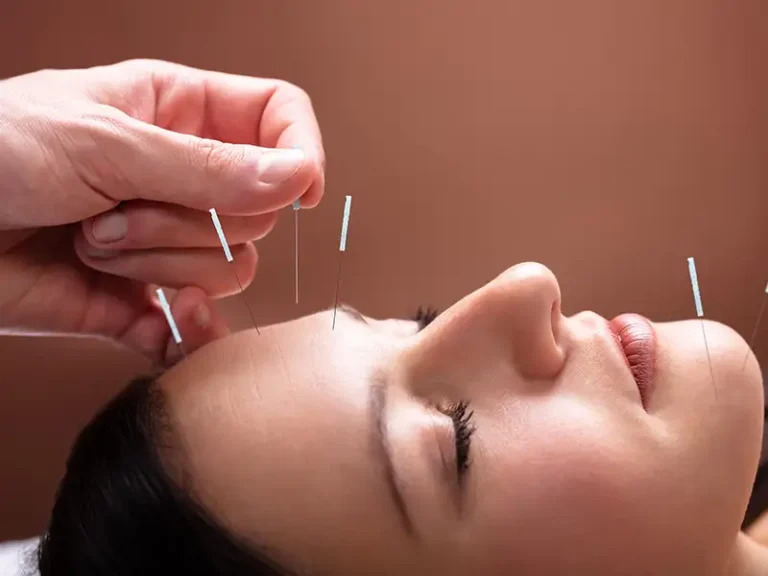 Facial Acupuncture