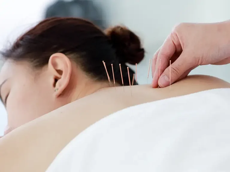 acupuncture