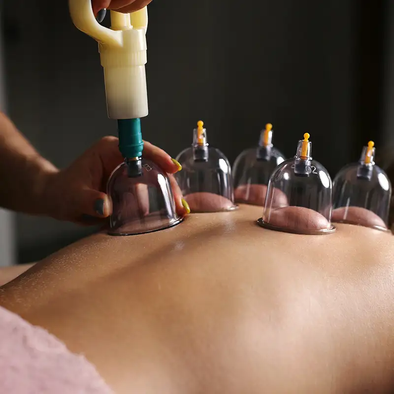 chinese cupping therapy